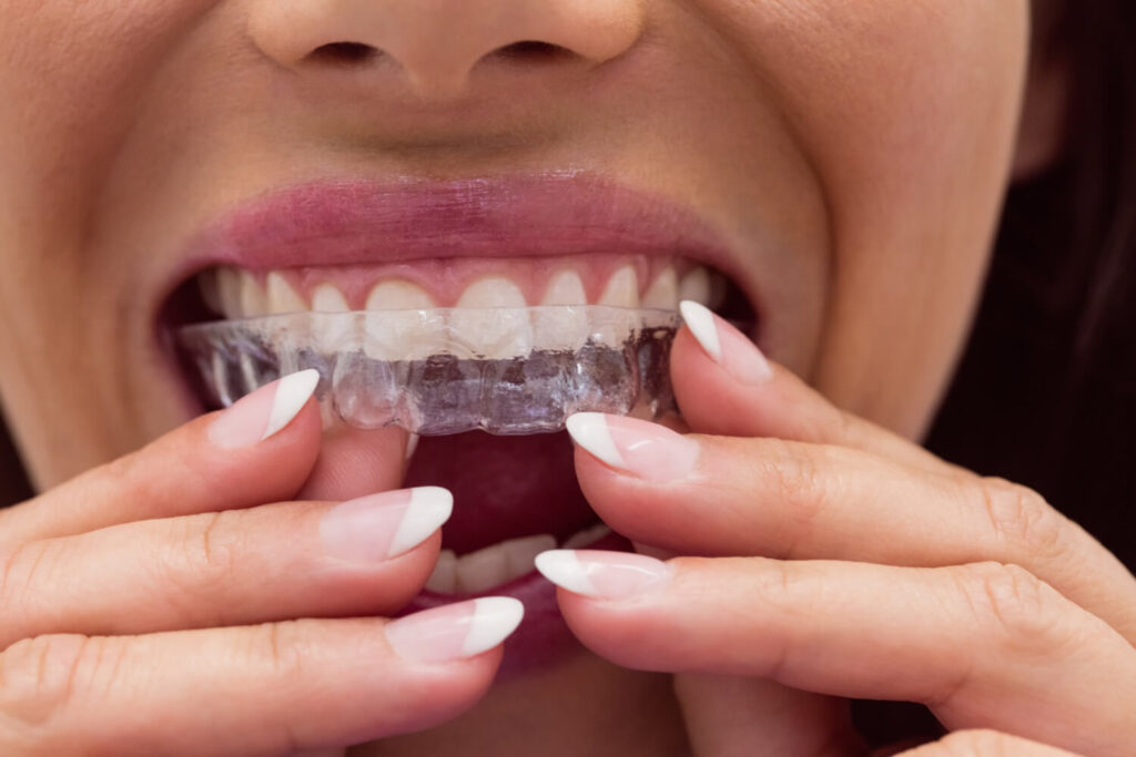 Mulher colocando alinhador nos dentes mostra a rotina das consultas de Invisalign na Perrella Odontologia em São Caetano do Sul