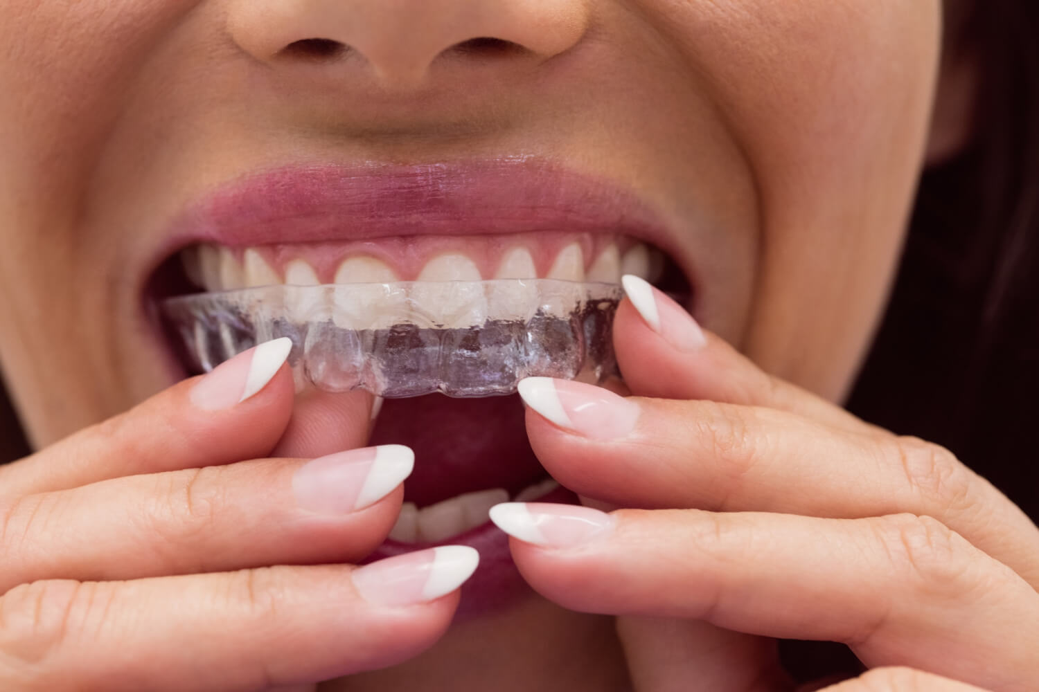 Mulher colocando alinhador nos dentes mostra a rotina das consultas de Invisalign na Perrella Odontologia em São Caetano do Sul